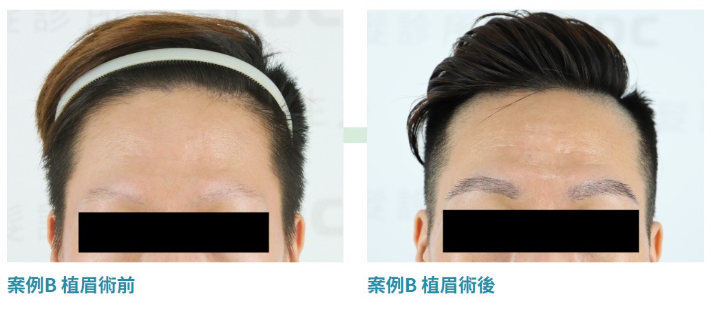 DCDC專業植眉手術案例B